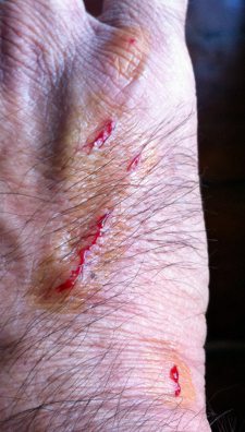 scratched hand